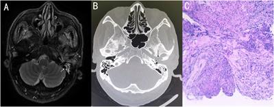 Case Report: The application of metagenomic next generation sequencing in diagnosing fungal malignant external otitis: a report of two cases